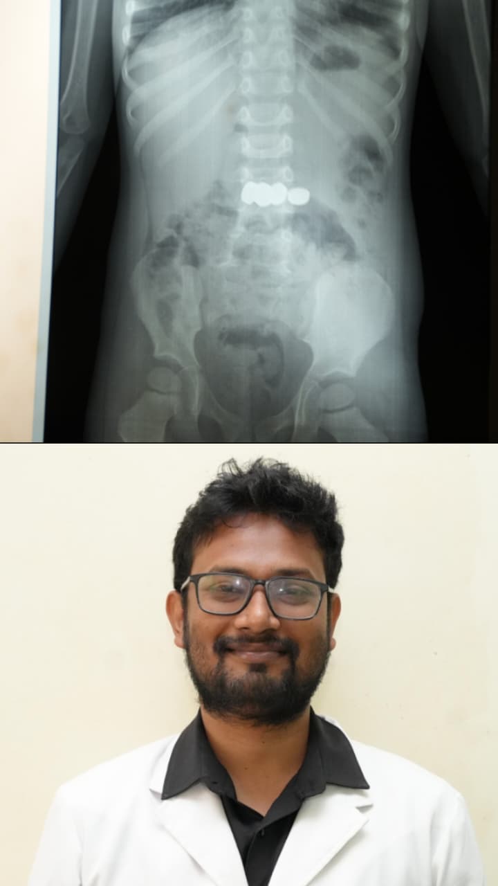 രണ്ട് വയസ്സുകാരൻ വിഴുങ്ങിയ അഞ്ച് ബാറ്ററികൾ എൻഡോസ്കോപ്പിയിലൂടെ സുരക്ഷിതമായി പുറത്തെടുത്തു