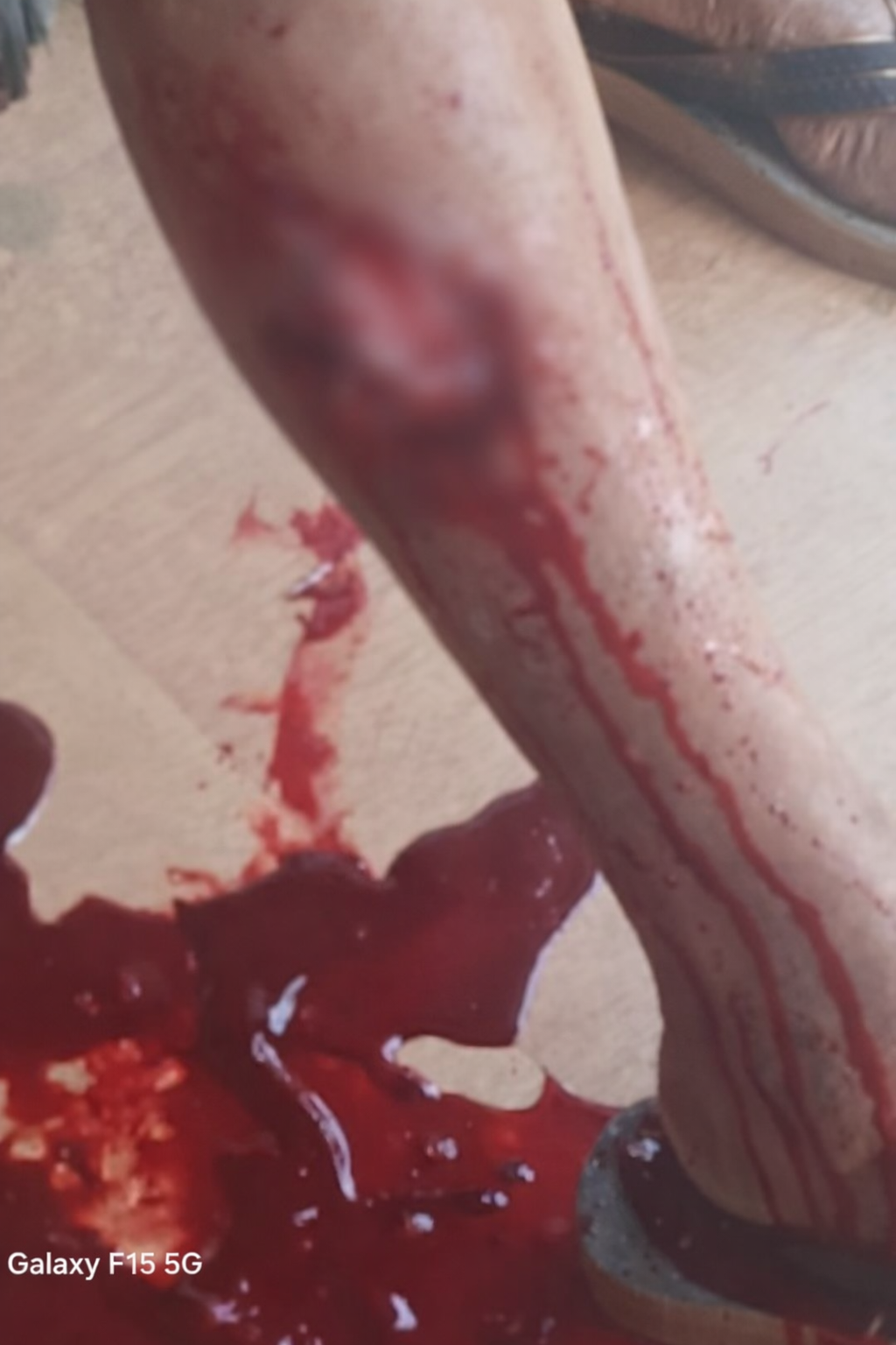 തേറ്റമല പ്രദേശത്ത് തെരുവ് നായ ആക്രമണം;രണ്ട് പേർക്ക് കടിയേറ്റു